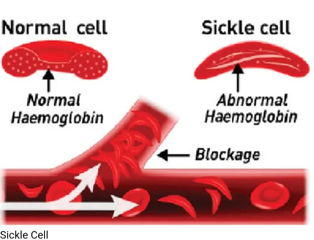 Sickle cell