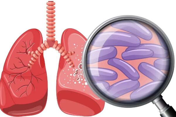 Over 440,000 TB Cases Identified in Nigeria