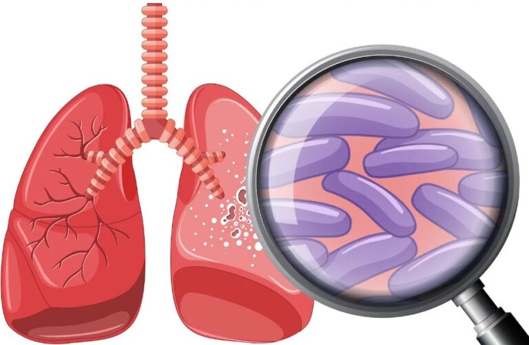 Over 440,000 TB Cases Identified in Nigeria