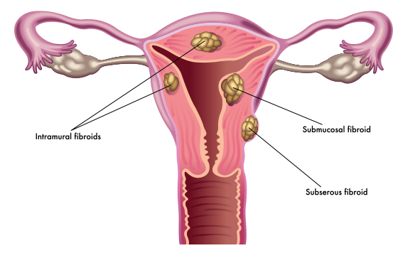 How Do I Manage Heavy Periods From Fibroids?