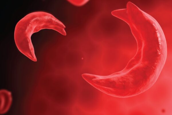Nigeria’s Sickle Cell Crisis Demands Urgent Action