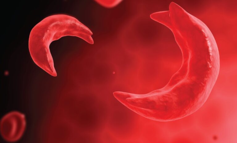 Nigeria’s Sickle Cell Crisis Demands Urgent Action